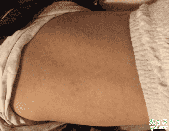 幼兒急疹有傳染性嗎 幼兒急疹會得第二次嗎4