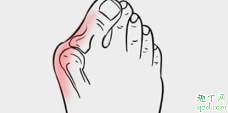 拇指外翻用手揉管用嗎 拇外翻能導(dǎo)致腳掌疼嗎2